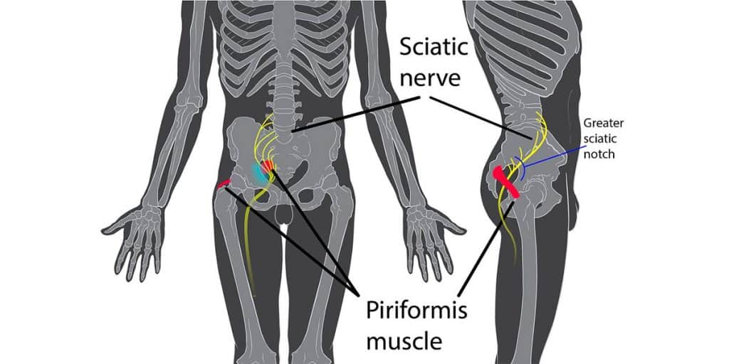 Sciatica vs Piriformis Syndrome